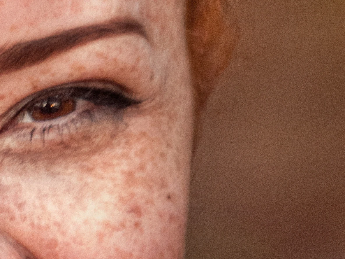Crow's feet softened, freckles kept — after
